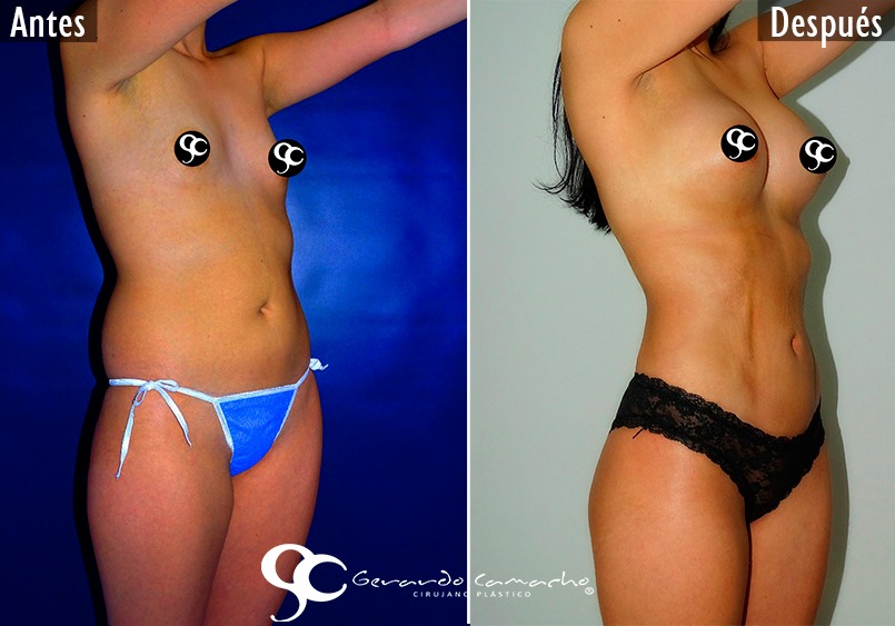 Testimonio Lipoescultura Gerardo Camacho